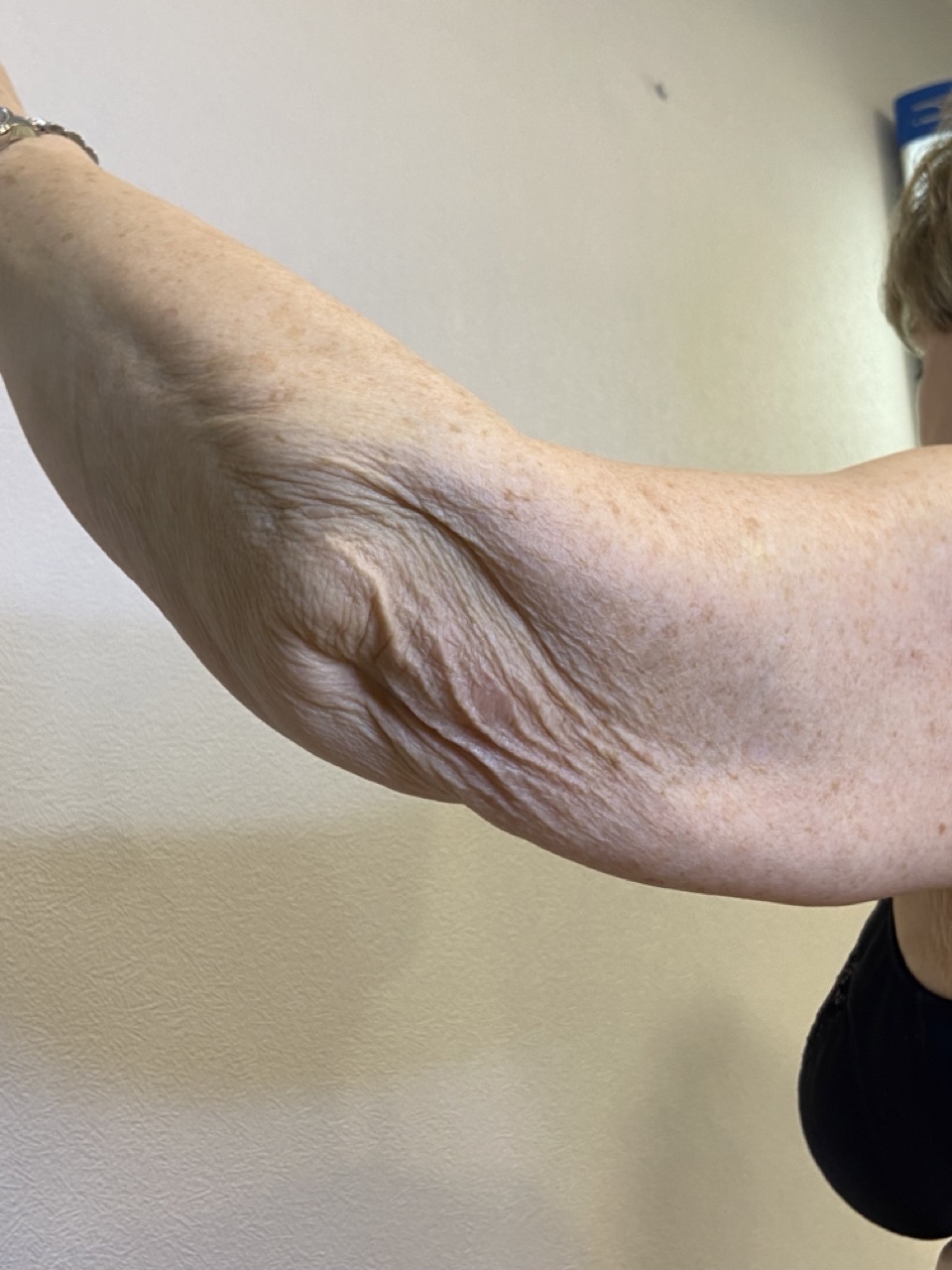 morpheus 2 antes anti flacidez