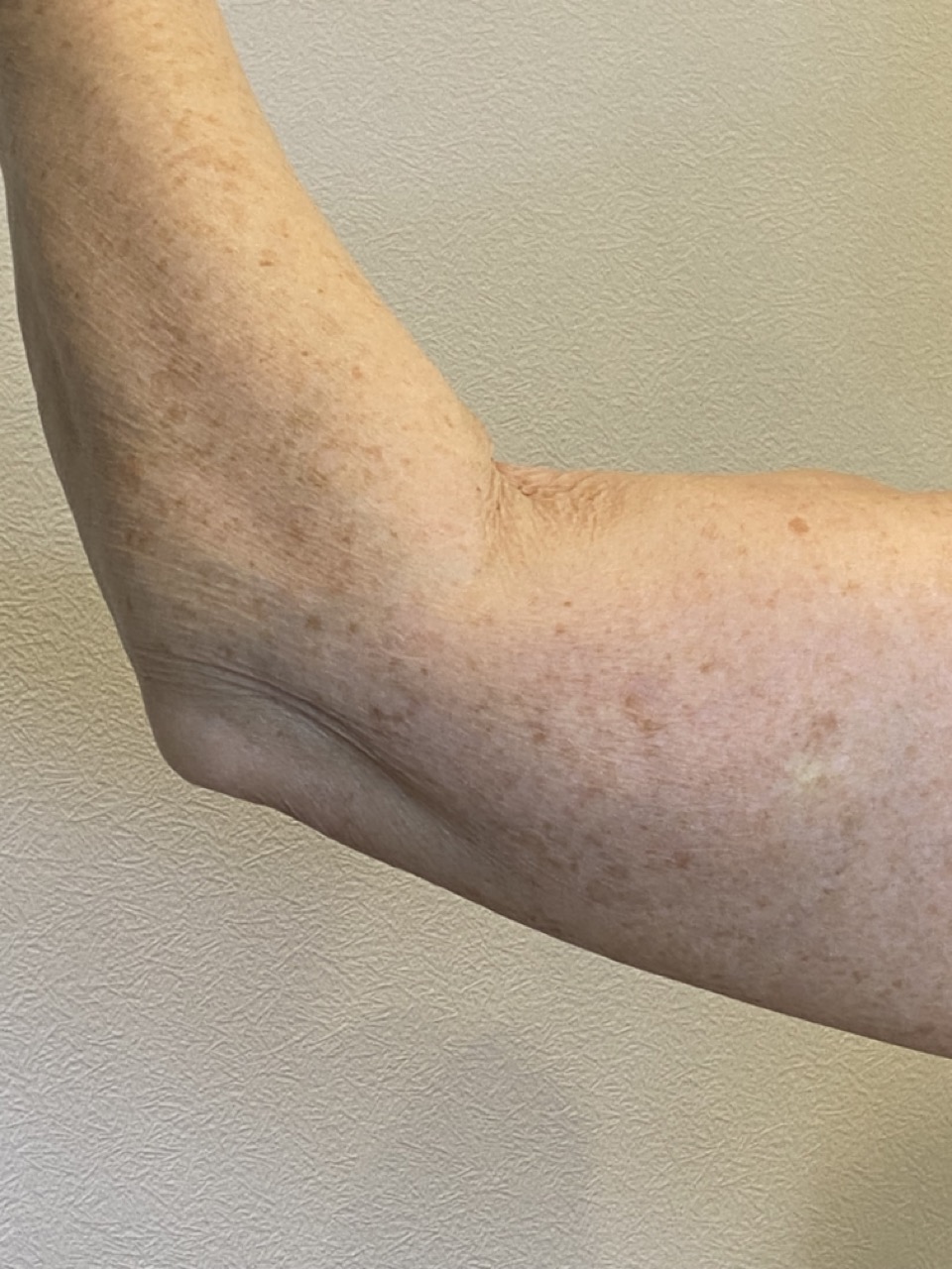 morpheus 2 despues anti flacidez