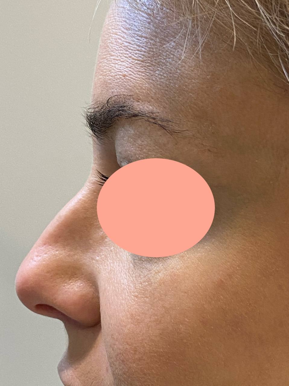 rinoplastica sin cirugía antes copia