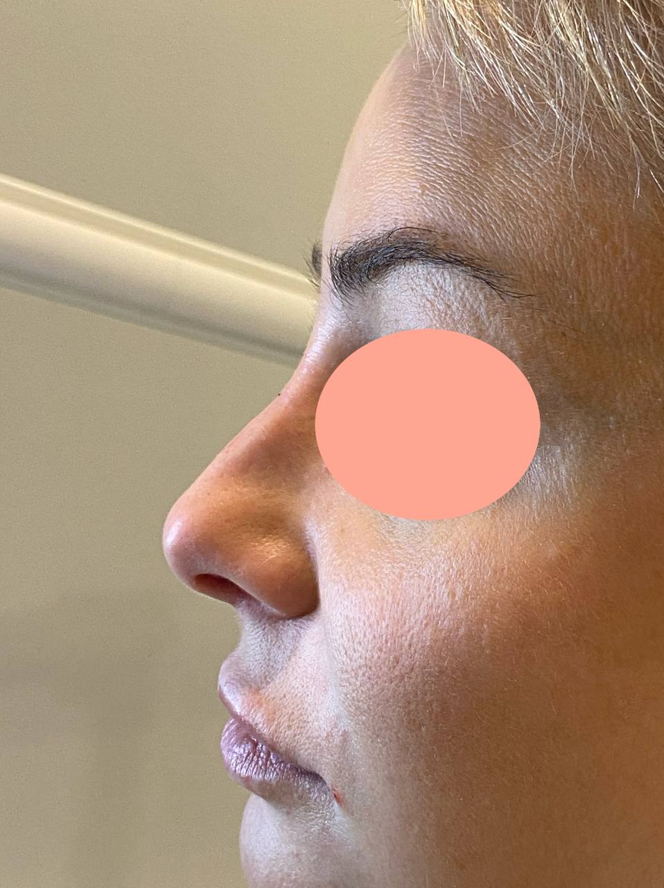 rinoplastica sin cirurgía despues copia