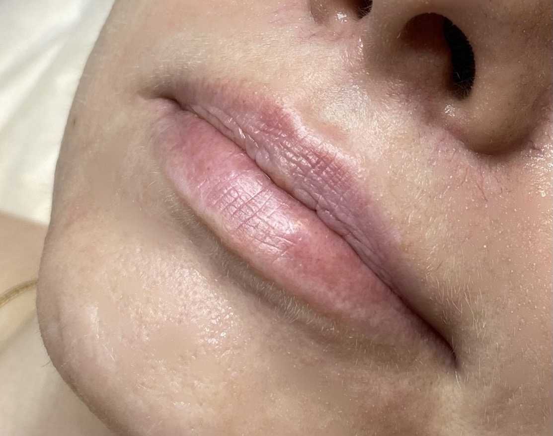 labios antes 3 en tamaño grande