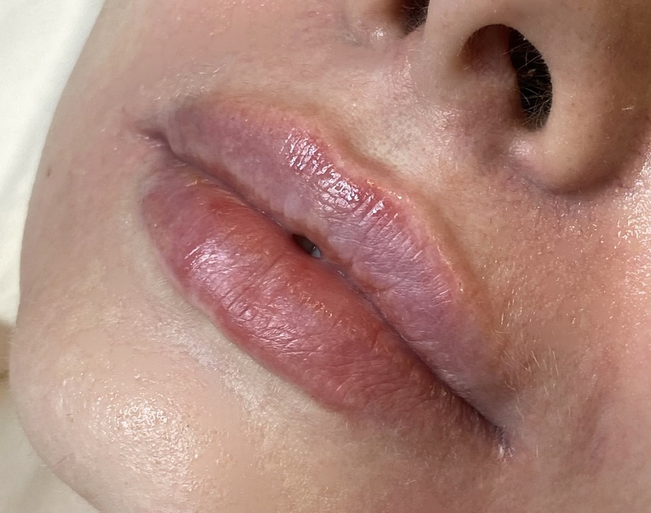 labios despues 3 en tamaño grande